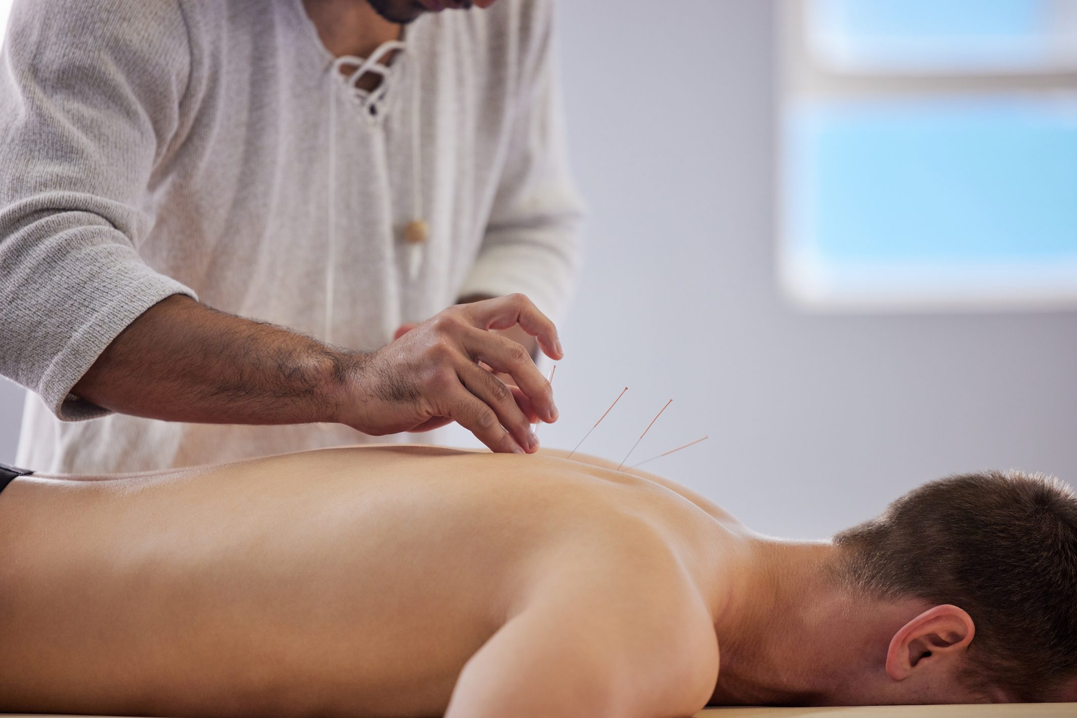 Shot of a acupuncturist treating a client Acupuncture in Walnut Creek Ca
