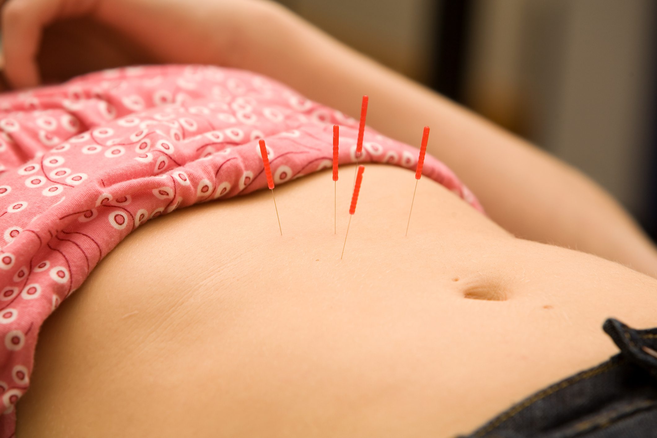 Female patient receiving acupuncture treatment on abdomen Acupuncture in Walnut Creek Ca
