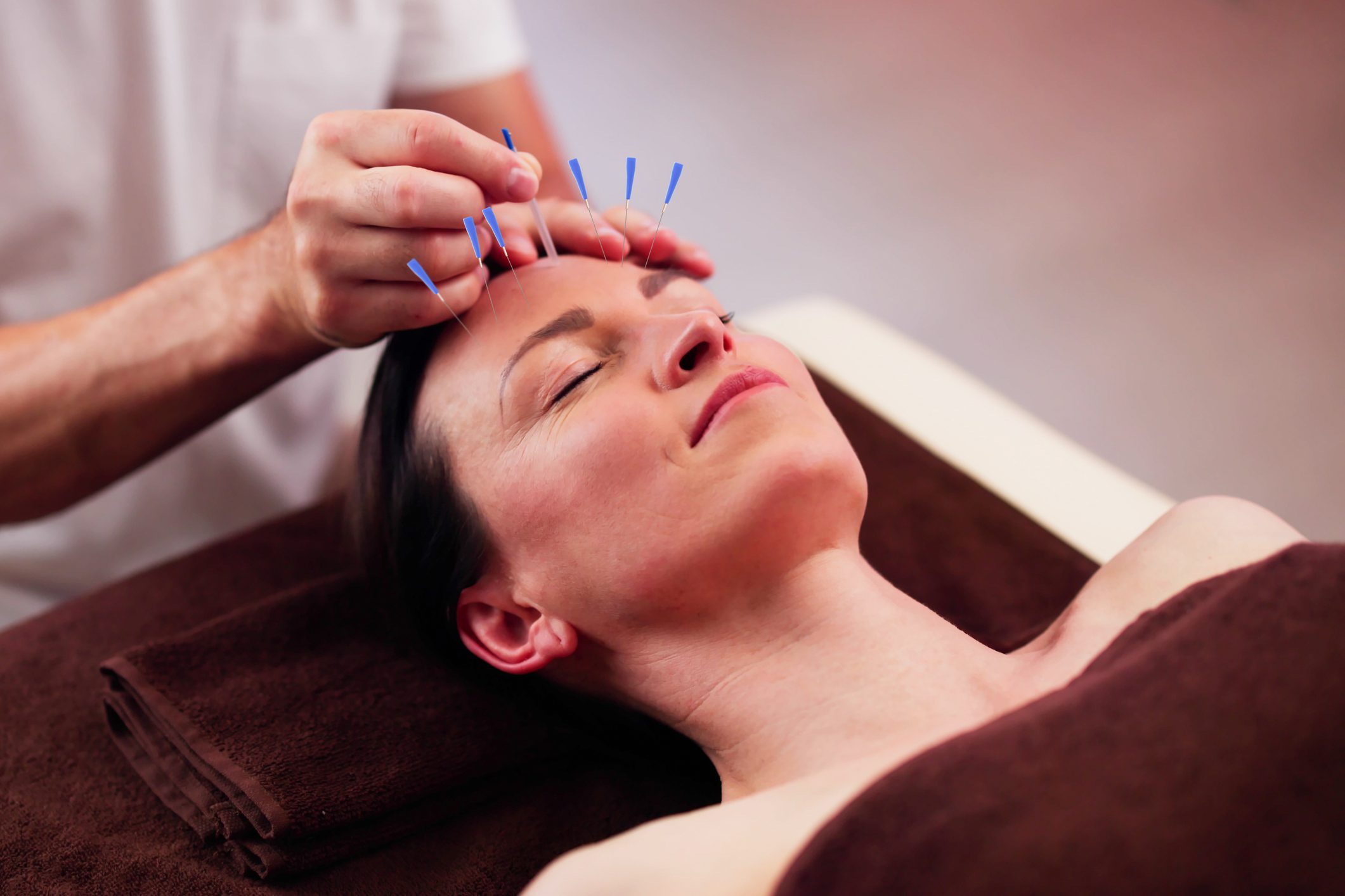 Relaxed Young Woman Receiving Acupuncture Treatment Acupuncture in Walnut Creek Ca