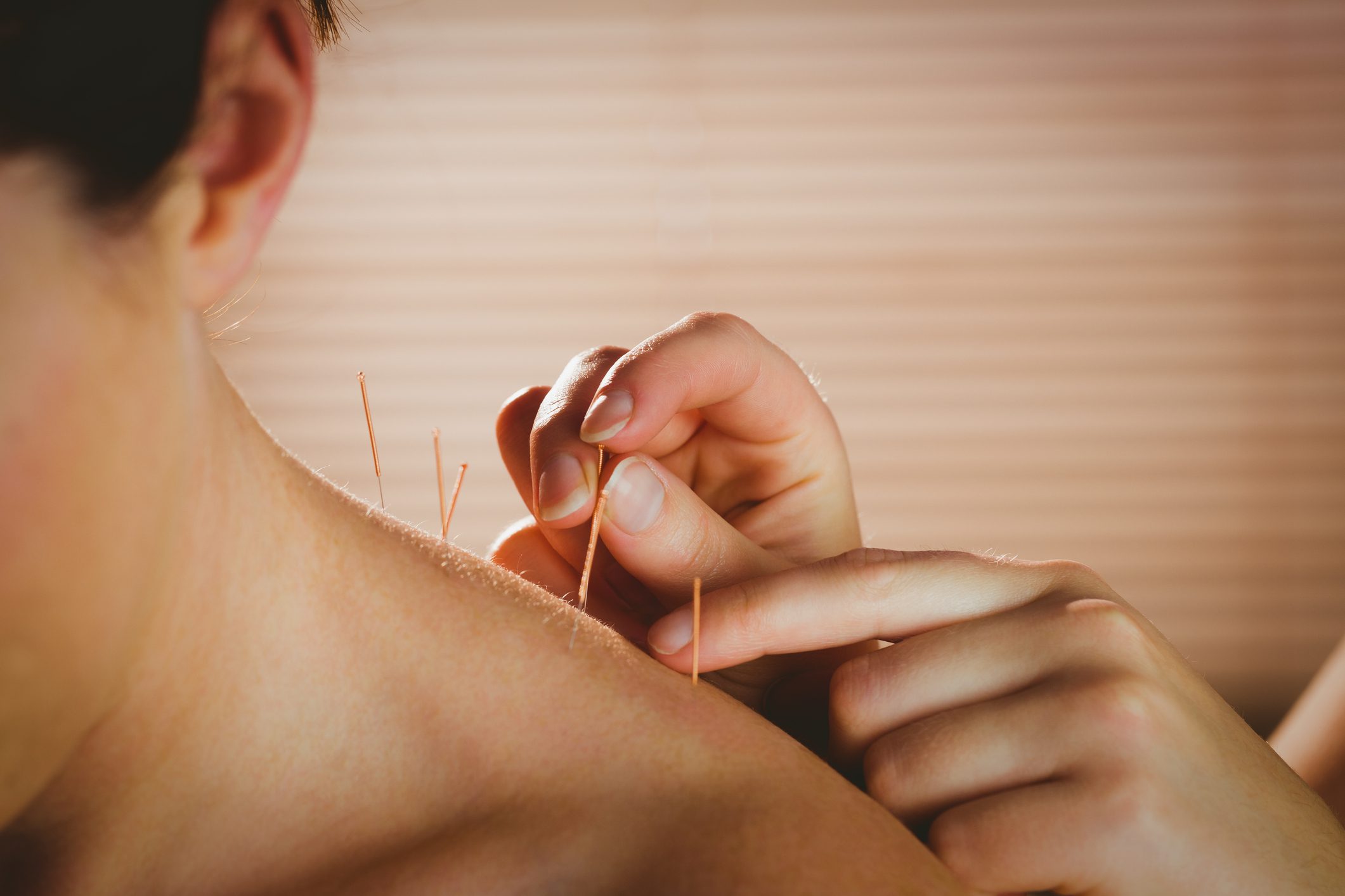 Young woman getting acupuncture treatment Acupuncture in Walnut Creek Ca